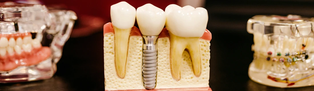 Dentist Northridge CA Dental Implant A model of a mouth with a dental implant.